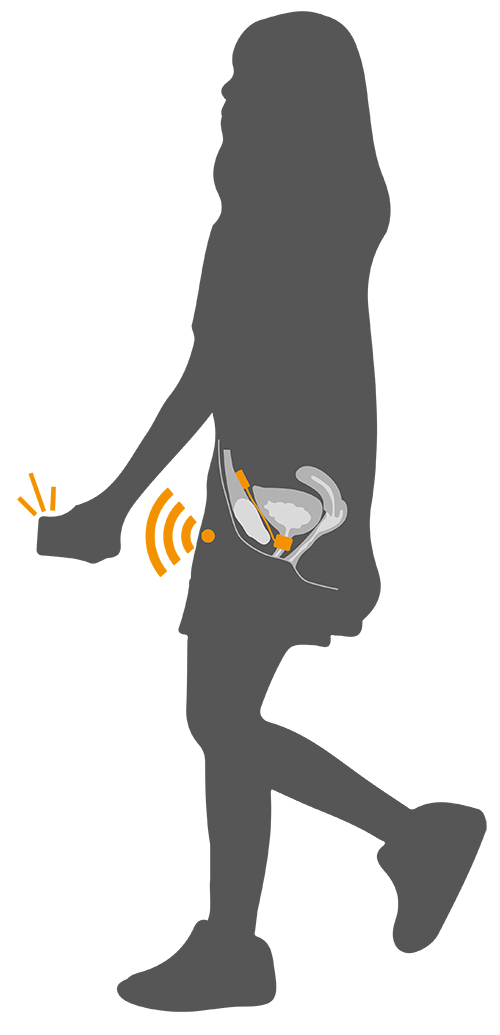 Andrew Conn AIMS robotic implants for Stress Induced Incontinence