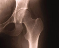 Hip x-ray