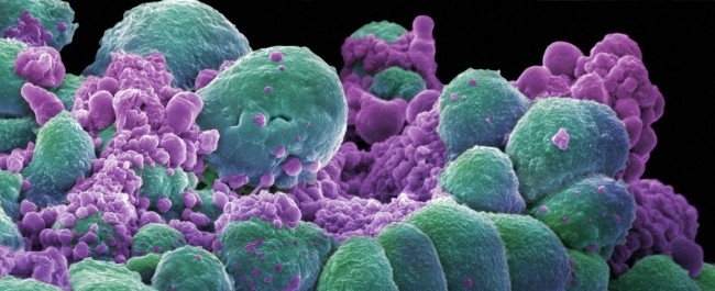 An image of some breast cancer cells
