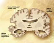 A diagram of a brain of a person with Alzheimer's disease