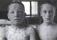 Two boys who were exposed to smallpox on the same day. Only the one on the right had been vaccinated.