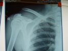 thumb_james_clavicle.jpg