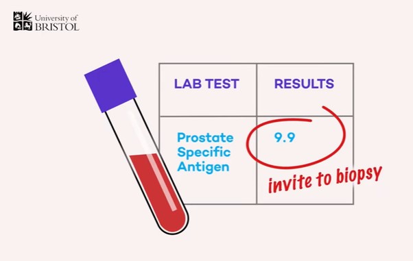 A table looking at PSA results and whether a biopsy would be required
