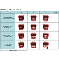 The TABBY tongue assessment tool, a chart for clinicians to use to assess ankyloglossia or 'tongue-tie' in infants.