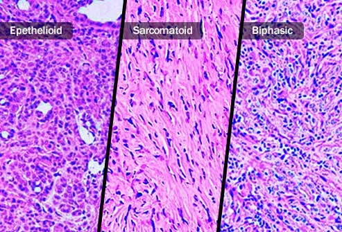 Micrographs of epithelioid and sarcomatoid cells.