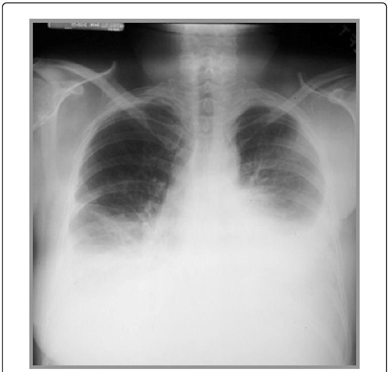 An x-ray of a patient suffering from a non-malignant pleural effusion.