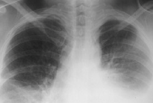 An x-ray of a patient suffering from a non-malignant pleural effusion.