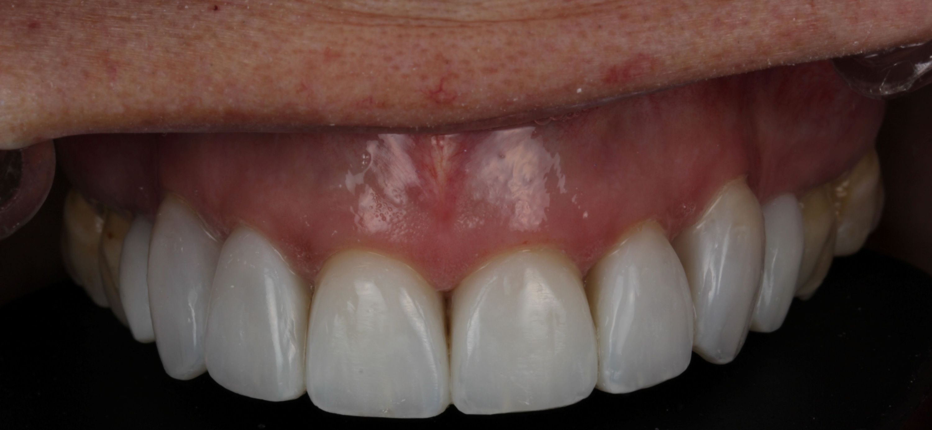 Top row of teeth that have been whitened and shaped