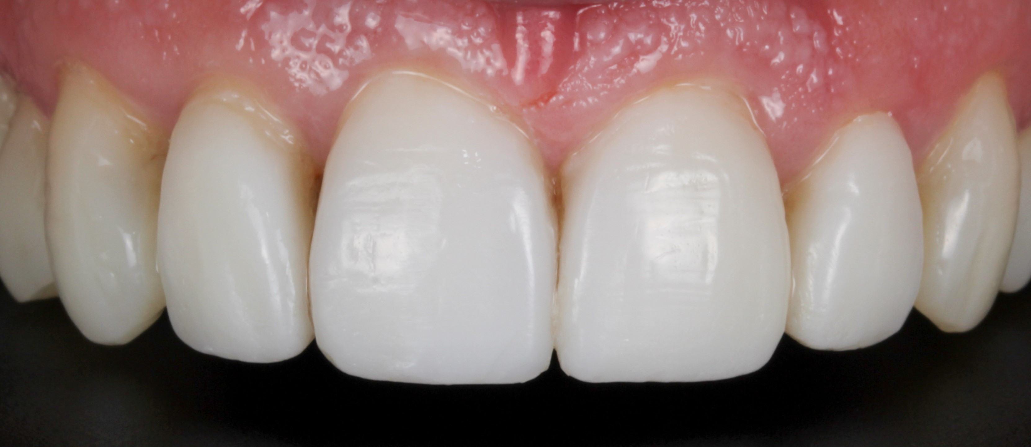 a fully restored smile after restorative treatment
