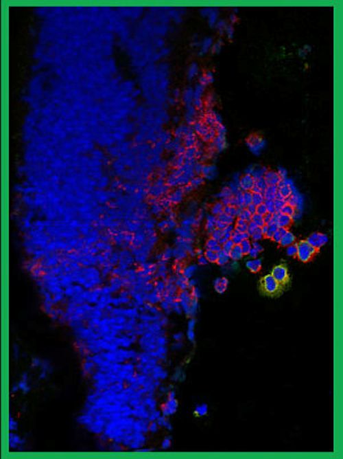 Micrograph of immune cells infiltrating the eye