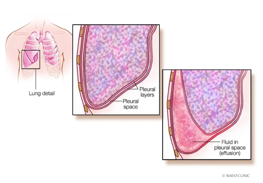 diagram of lung detail showcasing pleural space