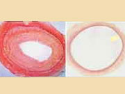 Before (left) and after a vein graft, using an Extent to cover the graft.