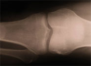 X-ray of a knee