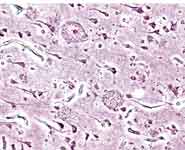 Histopathogic image of senile plaques seen in the cerebral cortex in a patient with Alzheimer disease of presenile onset.