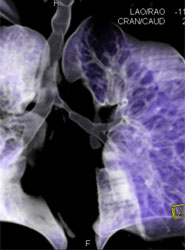 The diseased lung