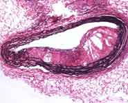 A soluable N-cadherin plaque with more stable phenotype features