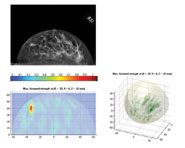 Images of the same breast taken by X-ray (left) and by MARIA (bottom left) which can also be displayed in 3D (bottom right)