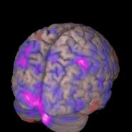 An MRI image of the human brain, over-layed with the pattern of activity as detected using MEG