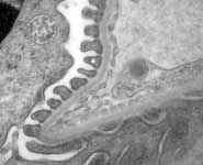 A normal filter of the kidney. One of the foot processes of the cell, called the podocyte, has been starred. This is the cell researchers think is important in the development of kidney failure secondary to diabetes.