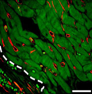 Formation of new vessels is diminished in diabetes…