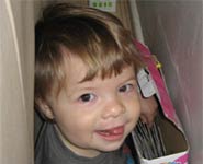 A toddler with a repaired unilateral cleft lip