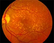 Intermediate age-related macular degeneration