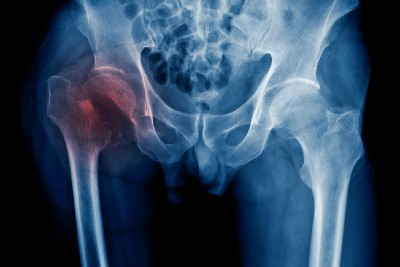No difference between spinal versus general anaesthesia in patients having hip fracture surgery, finds study