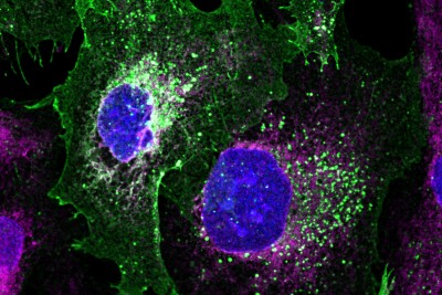 New DNA repair-kit successfully fixes hereditary disease in patient-derived cells – – University of Bristol – All news