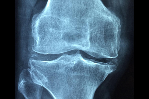 England’s Socio-Economic Divides in Joint Replacement Surgery Access