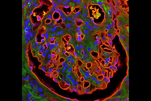 A glomerulus (kidney filter) from a patient with diabetes