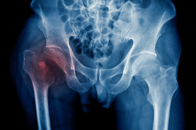 Significant variations in hip fracture health costs and care between NHS hospitals and regions, study finds –  – University of Bristol – All news