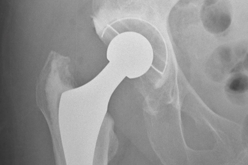 A hip replacement x-ray