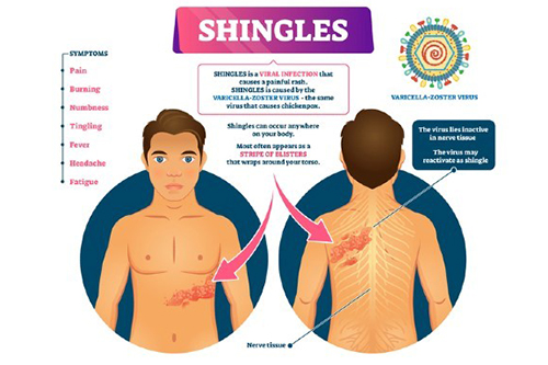 June: ATHENA shingles study | News and features