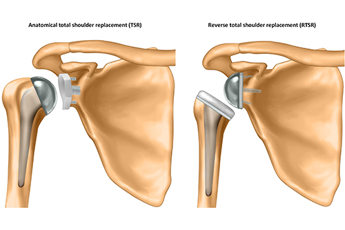 Anatomical and reverse total shoulder replacements