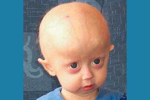 A young girl with progeria