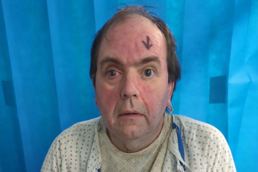 Toni in hospital before his cornea transplant