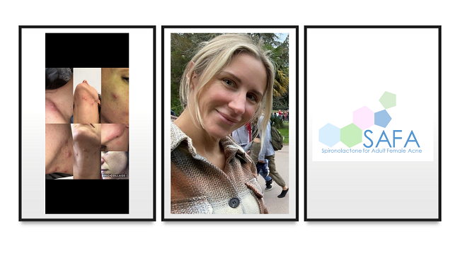 Before and after pictures of Kelly Cornick, who suffered from severe acne, which was successfully treated during the SAFA Trial.